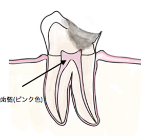 歯髄に到達した虫歯の状態。根管治療の適応になります。