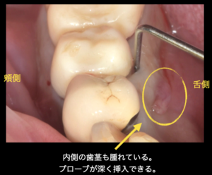 歯茎が腫れる｜デンタルクリニック麻布仙台坂 - 麻布十番駅の歯医者 