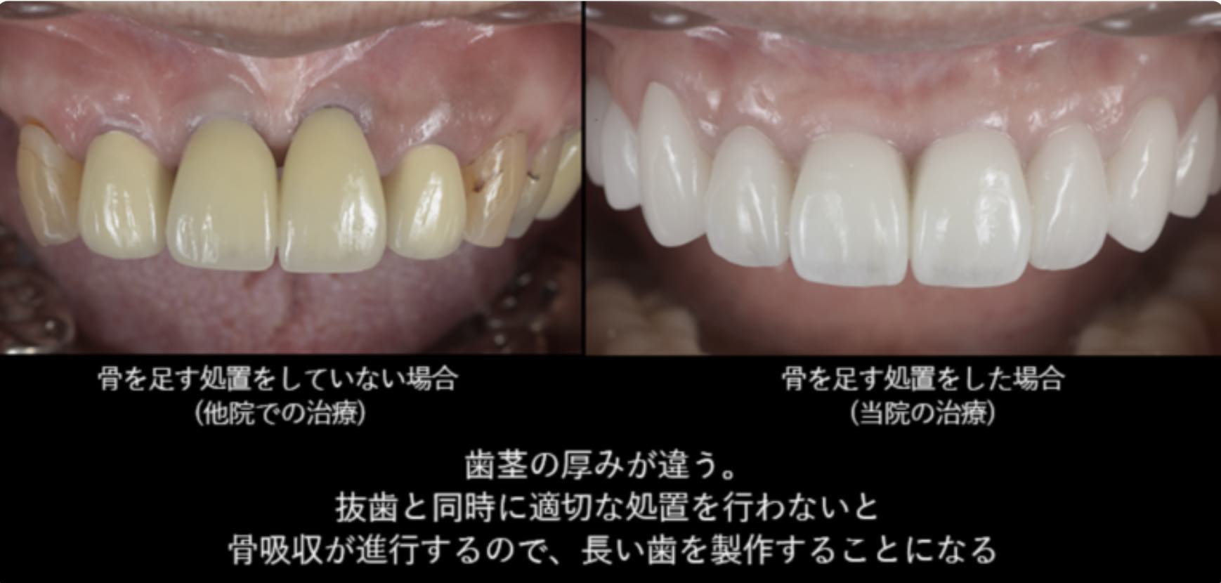インプラントのために前歯に骨を足す？前歯部インプラントにおける骨