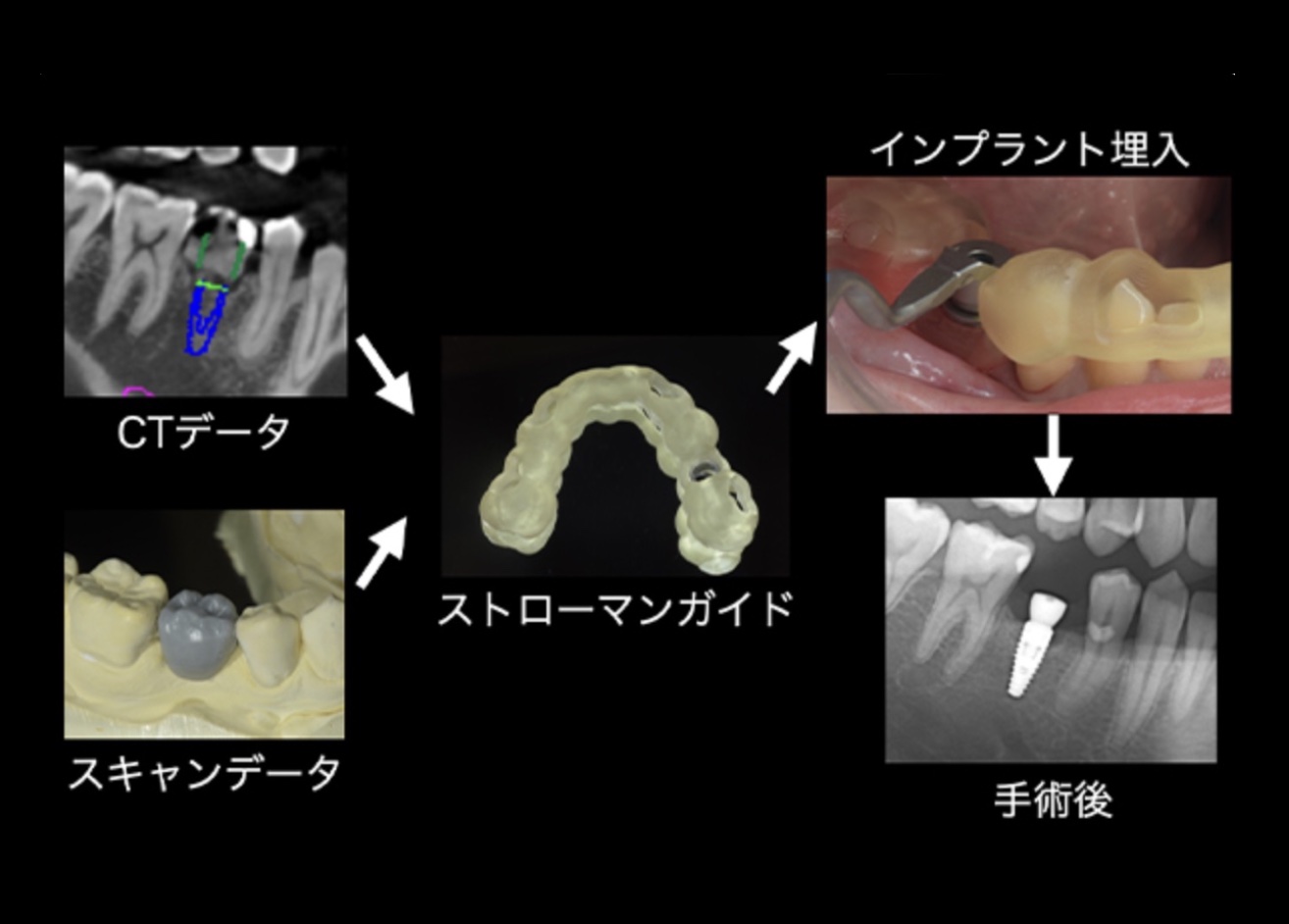 Q&Aでわかる 専門家が作った患者さんのための インプラント治療