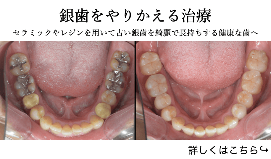 銀歯をやりかえる治療