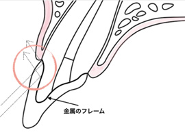 歯茎2