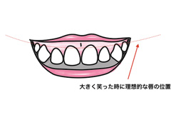 歯茎の見え方