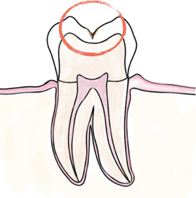 虫歯がエナメル質に限局するもの