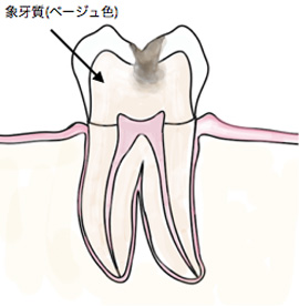 象牙質まで虫歯が進行した状態