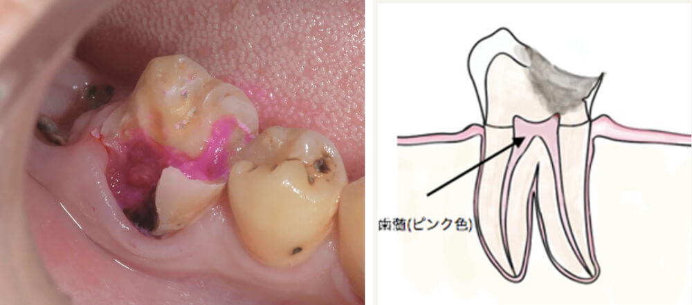 C3(歯髄に達するう蝕、歯髄炎)