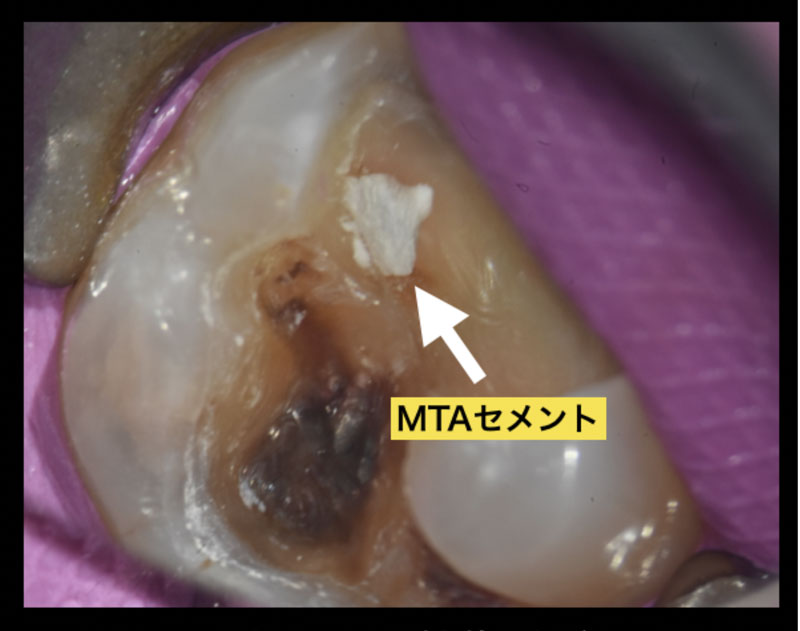 歯髄を温存して破折を回避する