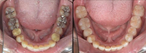 銀歯をセラミックにやりかえる治療