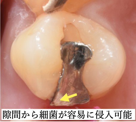 隙間から最近が用意に侵入可能