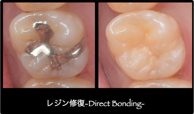 レジン修復