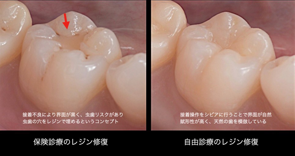 保険診療と自由診療のレジン修復比較