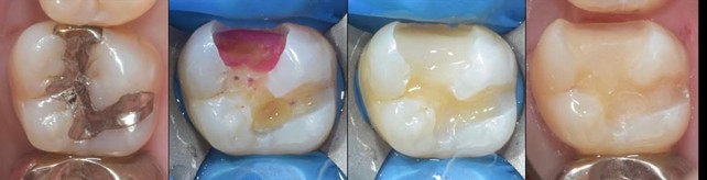 虫歯除去、裏層